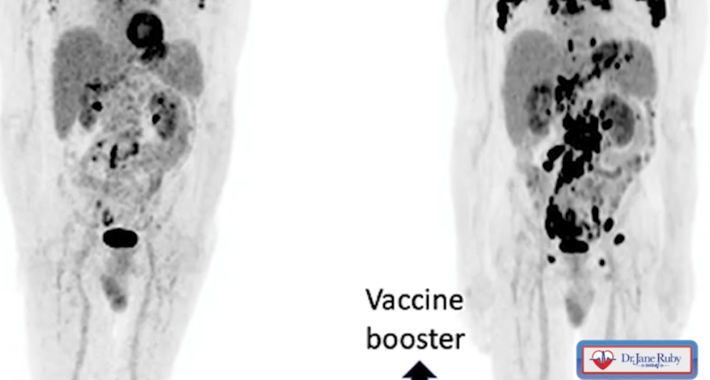 Krebs (links) versus Turbo Krebs Explosion nach Booster (rechts) (Quelle Dr. Jane Ruby Show)